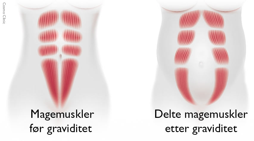 Rectusdiastase: delte magemuskler 